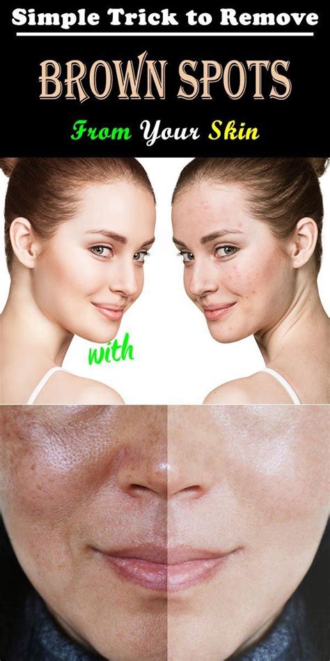 Simple Trick To Remove Brown Spots From Your Skin Spots On Face