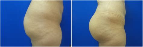 Buttock Implants Augmentation Photos