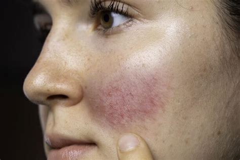 Rosacea Understanding The 4 Types And Treatment