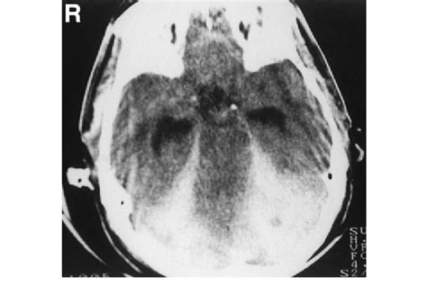 Computed Tomography Scan Showing Severe Subarachnoid Hemorrhage