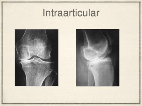 Correcting Varus Deformity Of The Knee In Total Knee Replacement