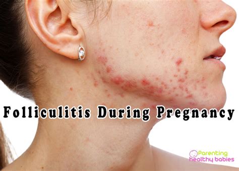 Folliculitis During Pregnancy Signs Symptoms And Natural Remedies