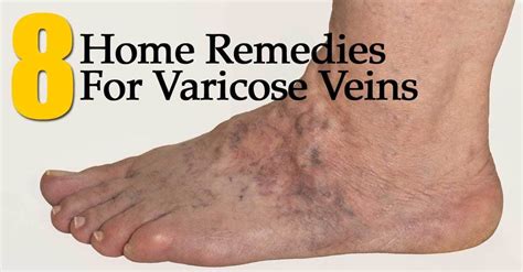 Veins On Top Of Foot