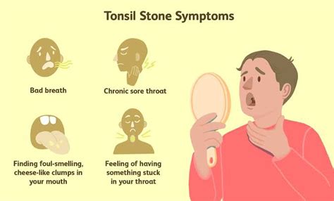 Everything You Need To Know About Tonsil Stones Symptoms And Treatment