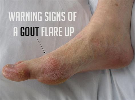 Prevent And Control Gout Or Uric Acid From Your Life