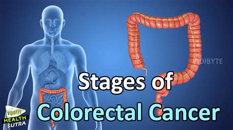 Stages Of Colorectal Cancer Health Tips Youtube
