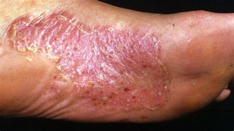 Palmoplantar Pustulosis Symptoms Causes And Treatment