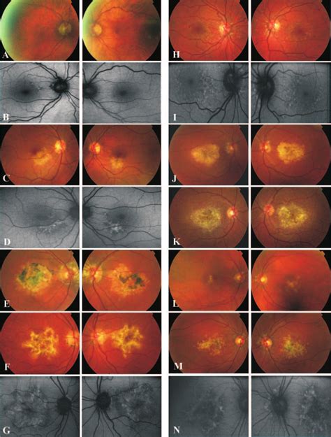 Fundus Photographs And Autofluorescence Images Demonstrating The
