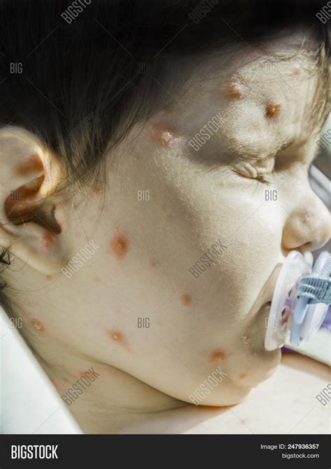 Close Up Shot Of Varicella Virus Or Chicken Pox Bubble Rash And Blister