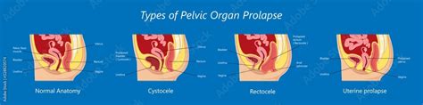 Vecteur Stock Pelvic Floor Prolapse Type Uterine Uterus Biofeedback Pelvic Floor Treatment Stage