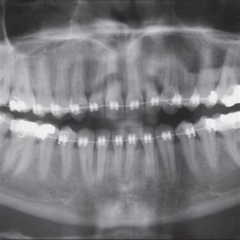Pdf Autotransplantation Of An Impacted Third Molar An Orthodontic