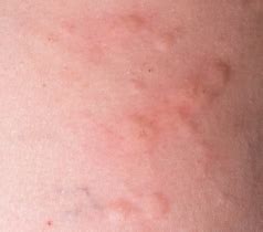 Hives can be triggered by many situations and substances,. Effective Cure For Hives