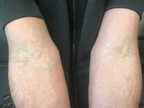 Cureus | Scarlatiniform Rash Caused by Mycoplasma pneumoniae