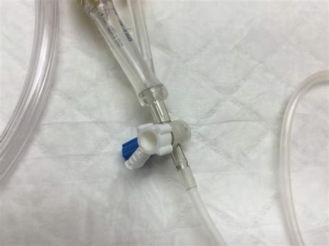 Trick Of The Trade Large Volume Paracentesis Technique Using Gravity