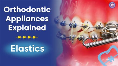 Orthodontic Appliances Explained Elastics Youtube