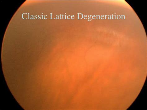 Ppt Classic Lattice Degeneration Powerpoint Presentation Free