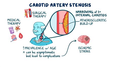 Carotid Artery Stenosis Screening Clinical Sciences Osmosis Video