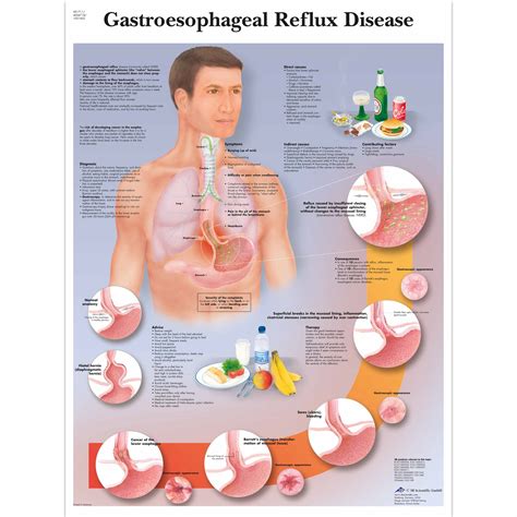 Anatomical Charts and Posters - Anatomy Charts - Digestive System Charts - GERD Chart ...
