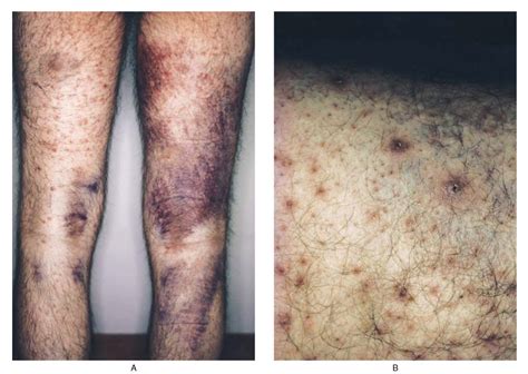 Skin Findings In A Patient With Scurvy Nejm