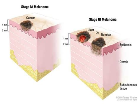 The Complete Guide To Melanoma Symptoms Causes And Cure