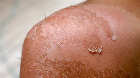 Sun Poisoning Symptoms Causes Treatment And More