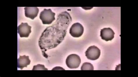 B) this is a type of. normal white blood cell count - YouTube