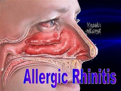 Allergic Rhinitisppt