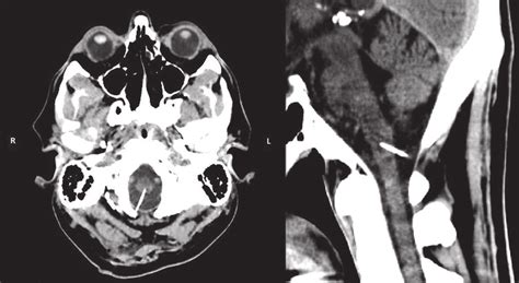 Noncontrast Computed Tomography Brain Showing Axial Left And Sagittal