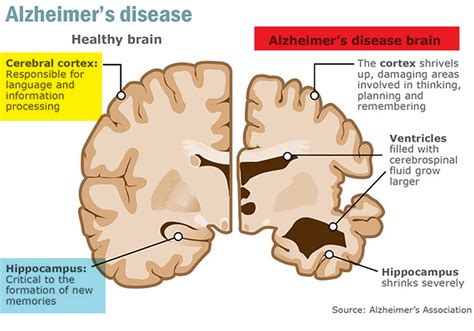 What Is Dementia Dementia Vs Alzheimers Disease