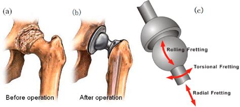 Damaged Natural Hip Joint A Artificial Hip Joint B And Schematic
