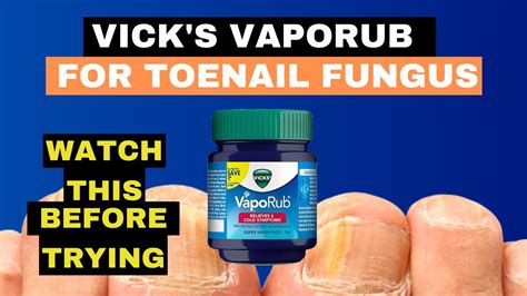 Vick S Vaporub For Nail Fungus Toe Fungus Journey Youtube