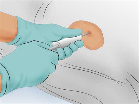 How To Diagnose Lupus 15 Steps With Pictures Wikihow