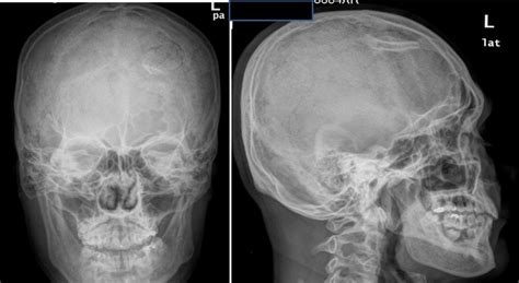 Depressed Skull Fracture Radiology Cases