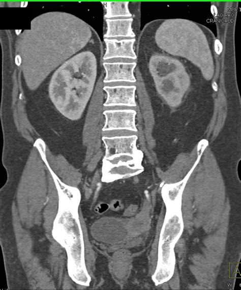 Bladder Cancer Obstructs The Left Ureter Genitourinary Case Studies