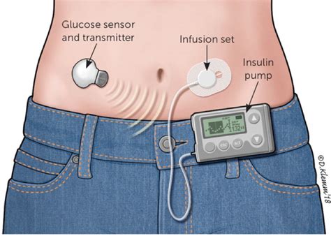 insulin pump catheter