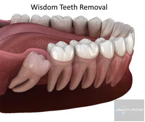 Wisdom Teeth Removal Oral Surgery For Impacted Molars Age Pain
