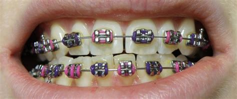 Purple And Pink Braces Teeth Braces Ceramic Braces Orthodontics