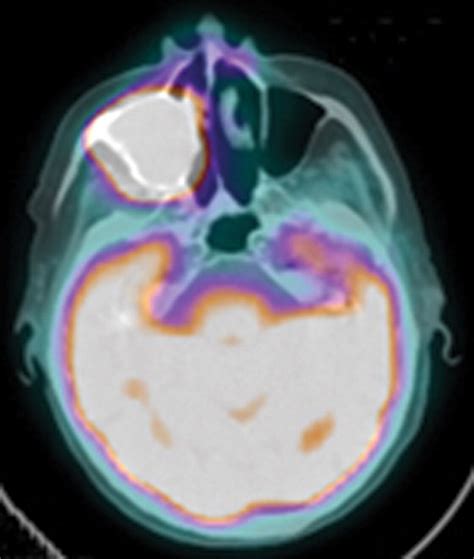 Pet Scan Images Of Stomach Cancer Nolyutesa