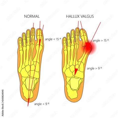 Illustration Of The Normal Foot And Hallux Valgus With Indicating Of The First