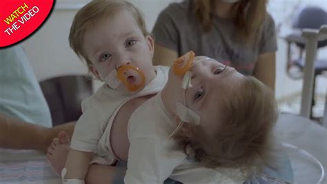 conjoined one year old twins born locked in an embrace separated in 11 hour surgery mirror online