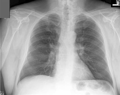 Longembolie en het umc utrecht. CXR Anatomy Quiz