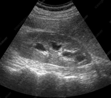 Enlarged Kidney Ultrasound Scan Stock Image C0034228 Science