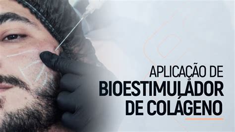 Aplicação de Bioestimulador de Colágeno Efeito Lifting YouTube