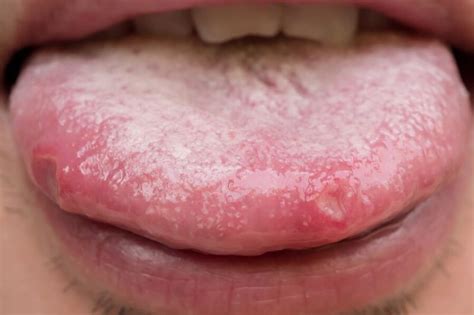 Cuáles son los síntomas de la candidiasis oral y el mal aliento
