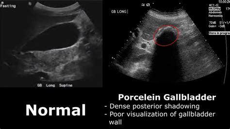Abnormal Gallbladder Ultrasound Images