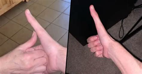 Guy S Super Long Thumb Has Gone Viral And It S 100 Real 22 Words