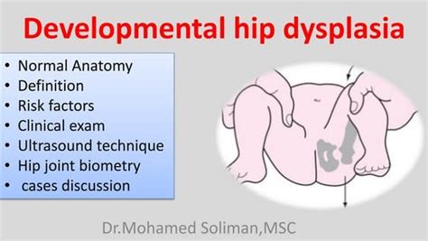Hip Dysplasia