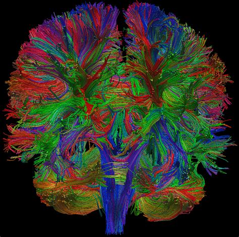 Diffusion Tensor Imaging DTI Of Human Brain Brain Diseases Human Brain Brain Art
