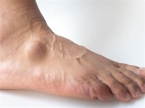 What Causes A Ganglion Cyst On Your Foot And Ankle Podiatry Hotline Foot Ankle Foot And
