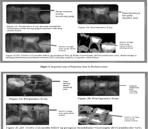 Figure 1 From Clinical And Radiographic Efficacy Of Portland Cement As